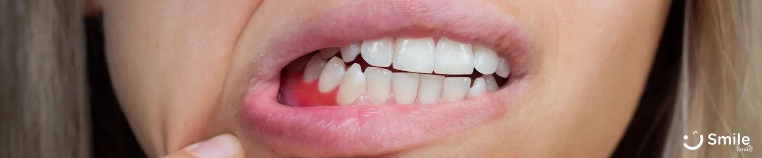 Gingivitis-nedir