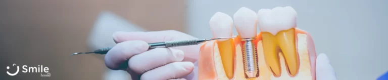 İmplant Tedavisi Nasıl Yapılır